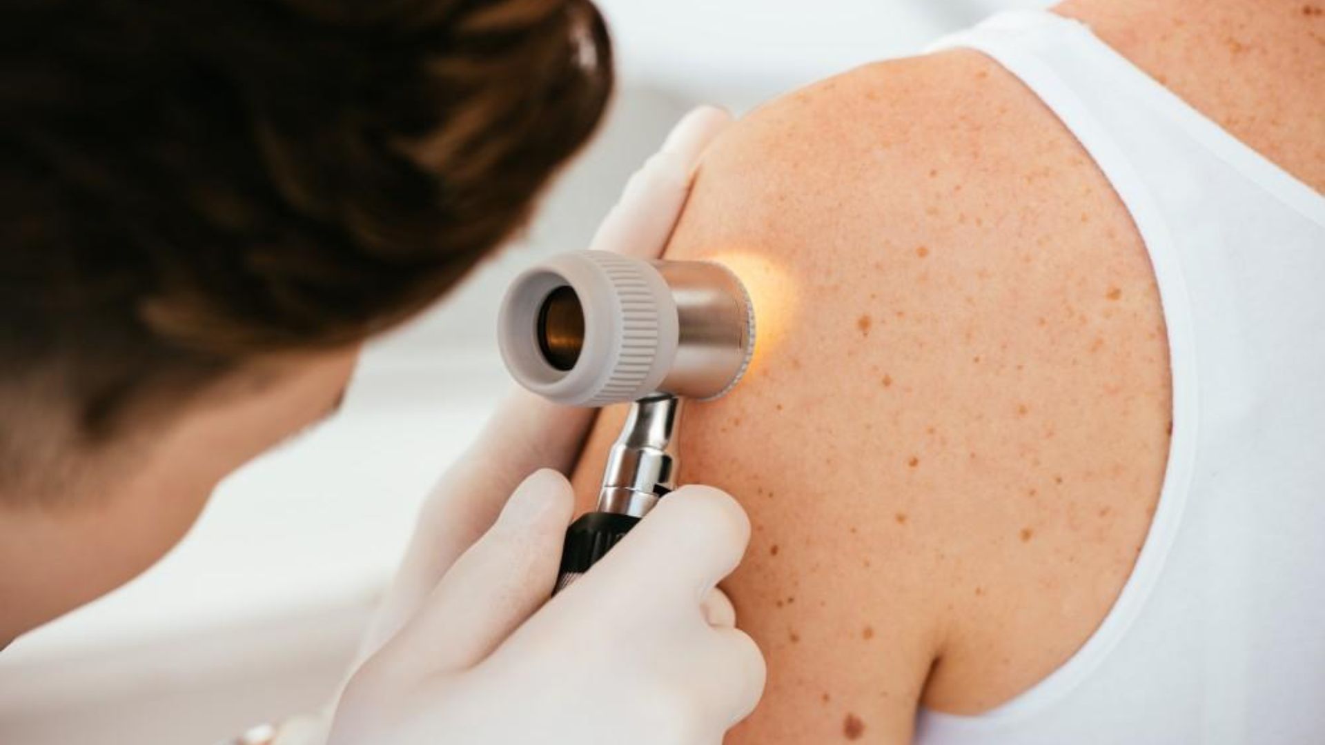 Which Skin Types Are Most at Risk and Need Regular Skin Cancer Screening?