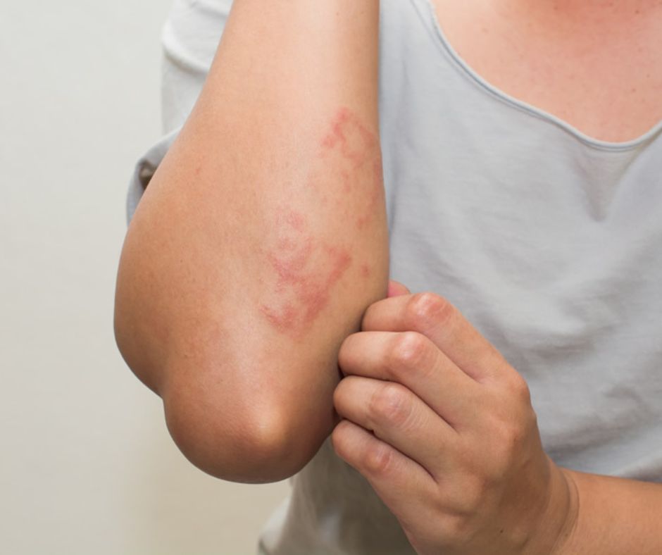 What Is the Most Effective Eczema Treatment for Long-Term Relief?