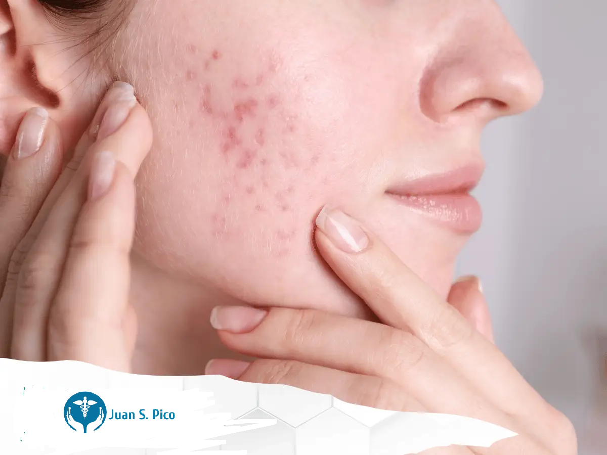 Can Dermatology Services Help Reduce Acne Scars and Dark Spots Permanently?
