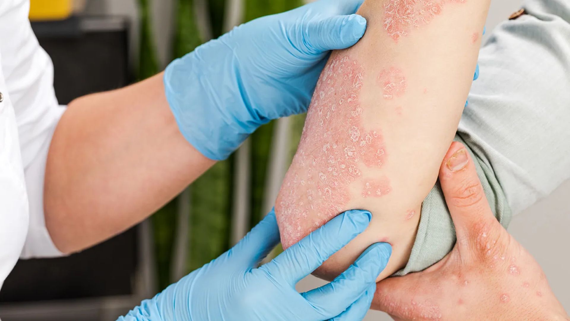 Eczema Treatment Tips for Managing Itching, Redness, and Dryness