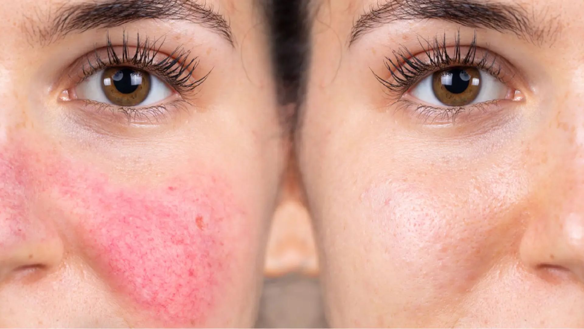 What Is the Best Treatment for Rosacea?